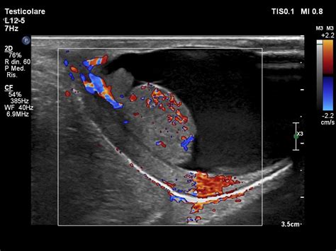 ultrasound images testicular torsion